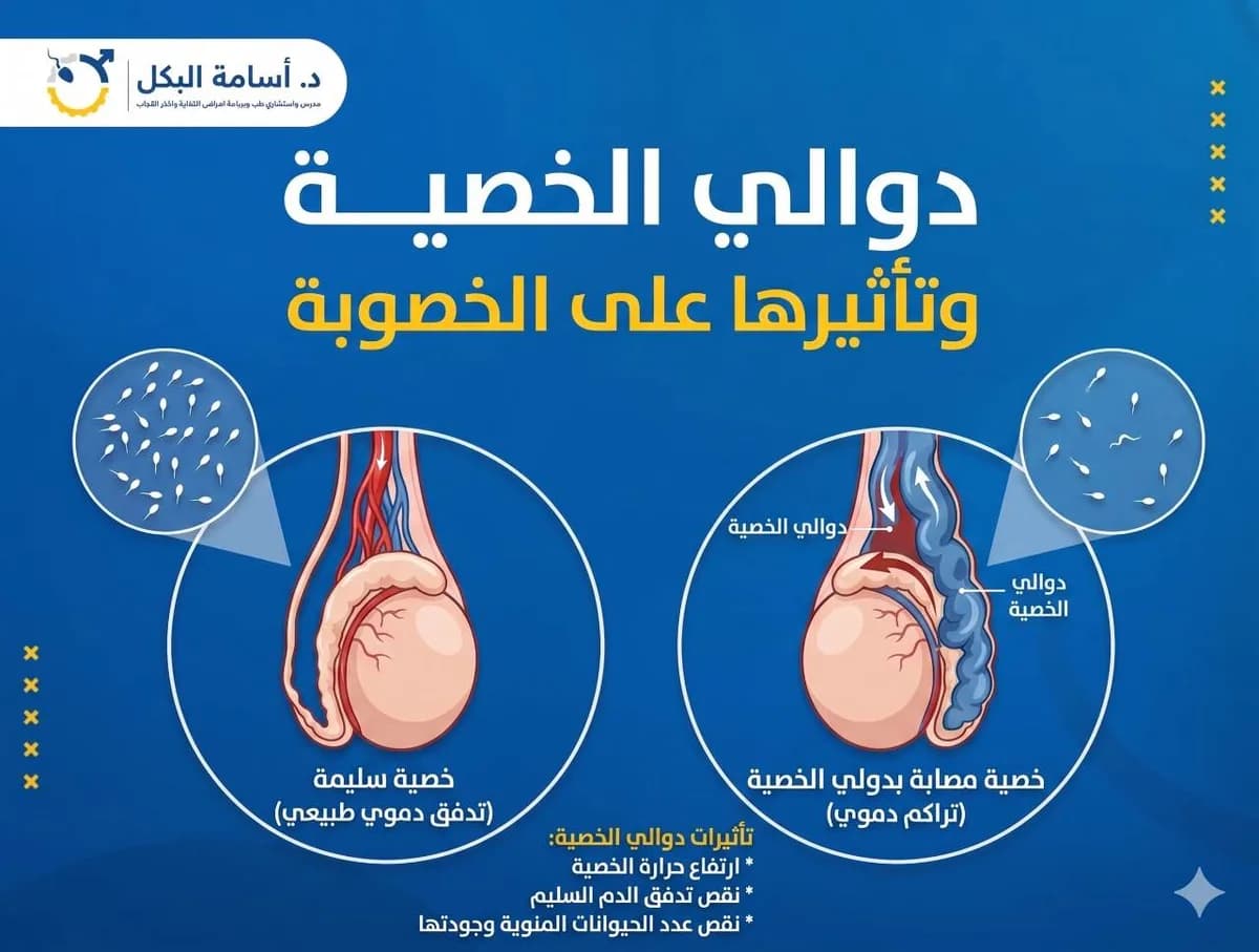 تكلفة عملية دوالي الخصية