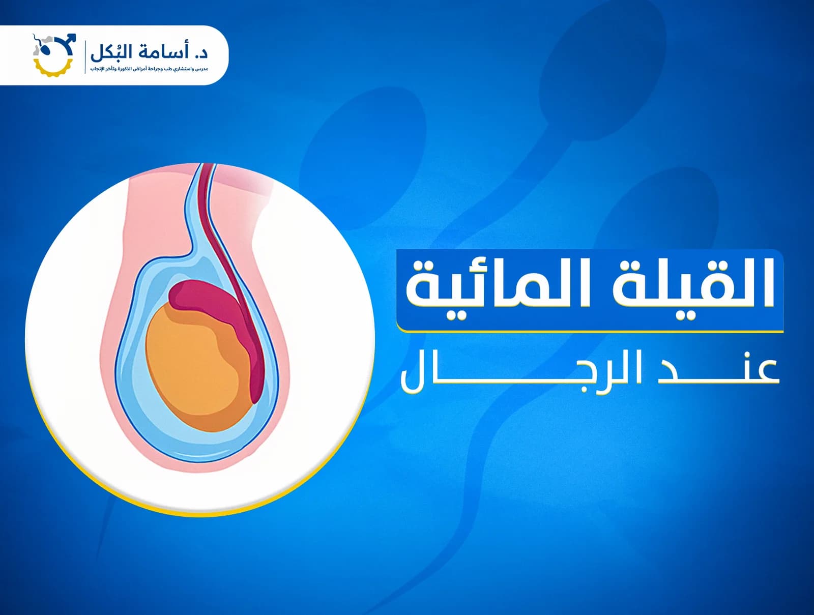 القيلة المائية عند الرجال