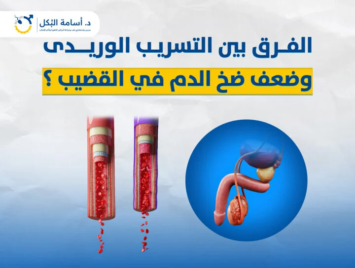 الفرق بين التسريب الوريدى وضعف ضخ الدم في القضيب؟