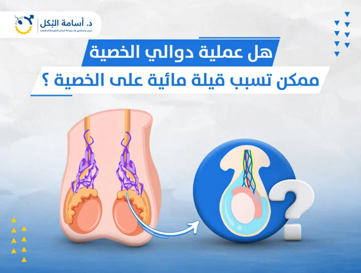 هل عملية دوالي الخصية ممكن تسبب قيلة مائية على الخصية؟