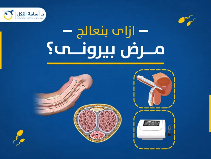 تشخيص وعلاج مرض بيروني