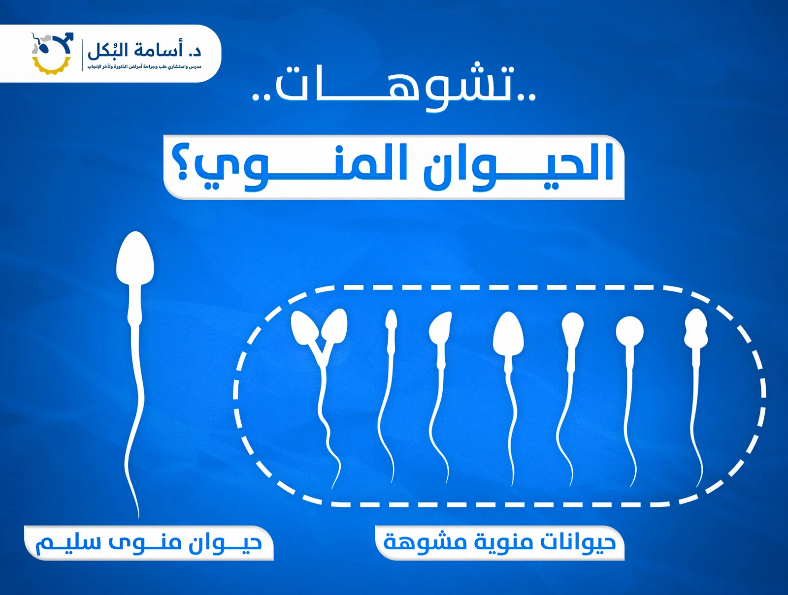 تشوهات الحيوان المنوي