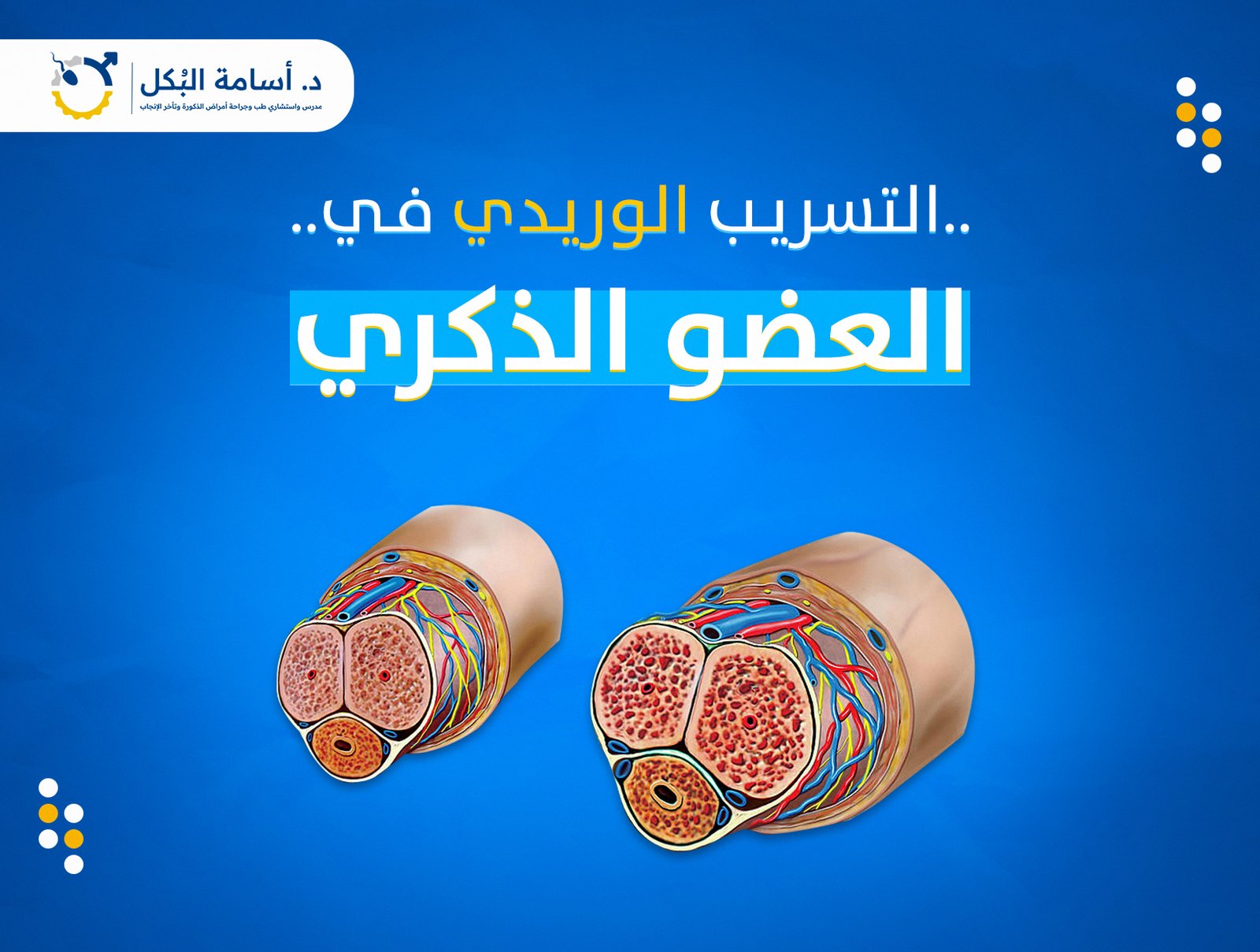 التسريب الوريدي في العضو الذكري
