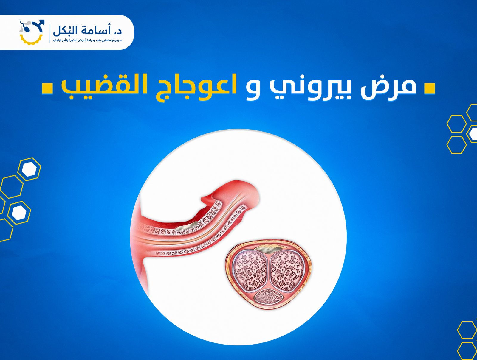مرض بيروني و اعوجاج القضيب