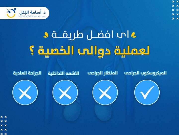 اي افضل طريقة لعملية دوالي الخصية ؟