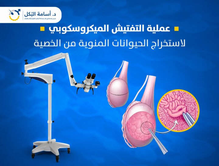 عملية التفتيش الميكروسكوبي لاستخراج الحيوانات المنوية من الخصية