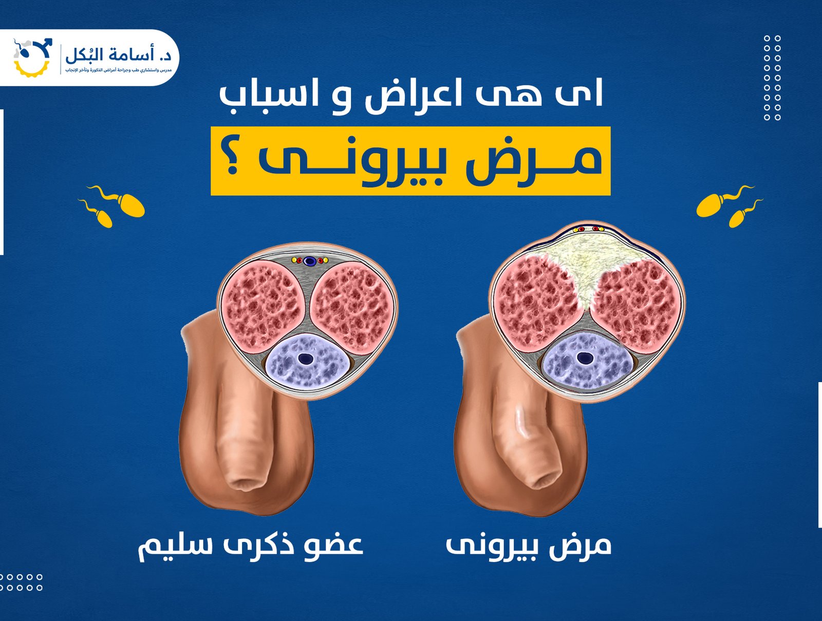ما هي اعراض و اسباب مرض بيرونى ؟