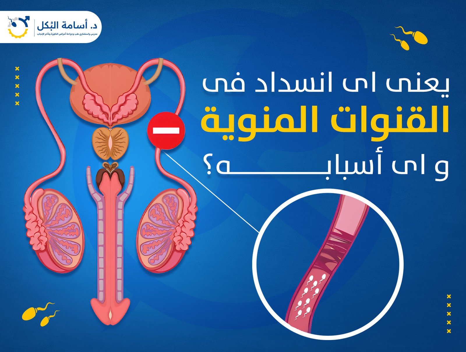  يعنى اى انسداد فى القنوات المنوية ، و اى أسبابه ؟ 