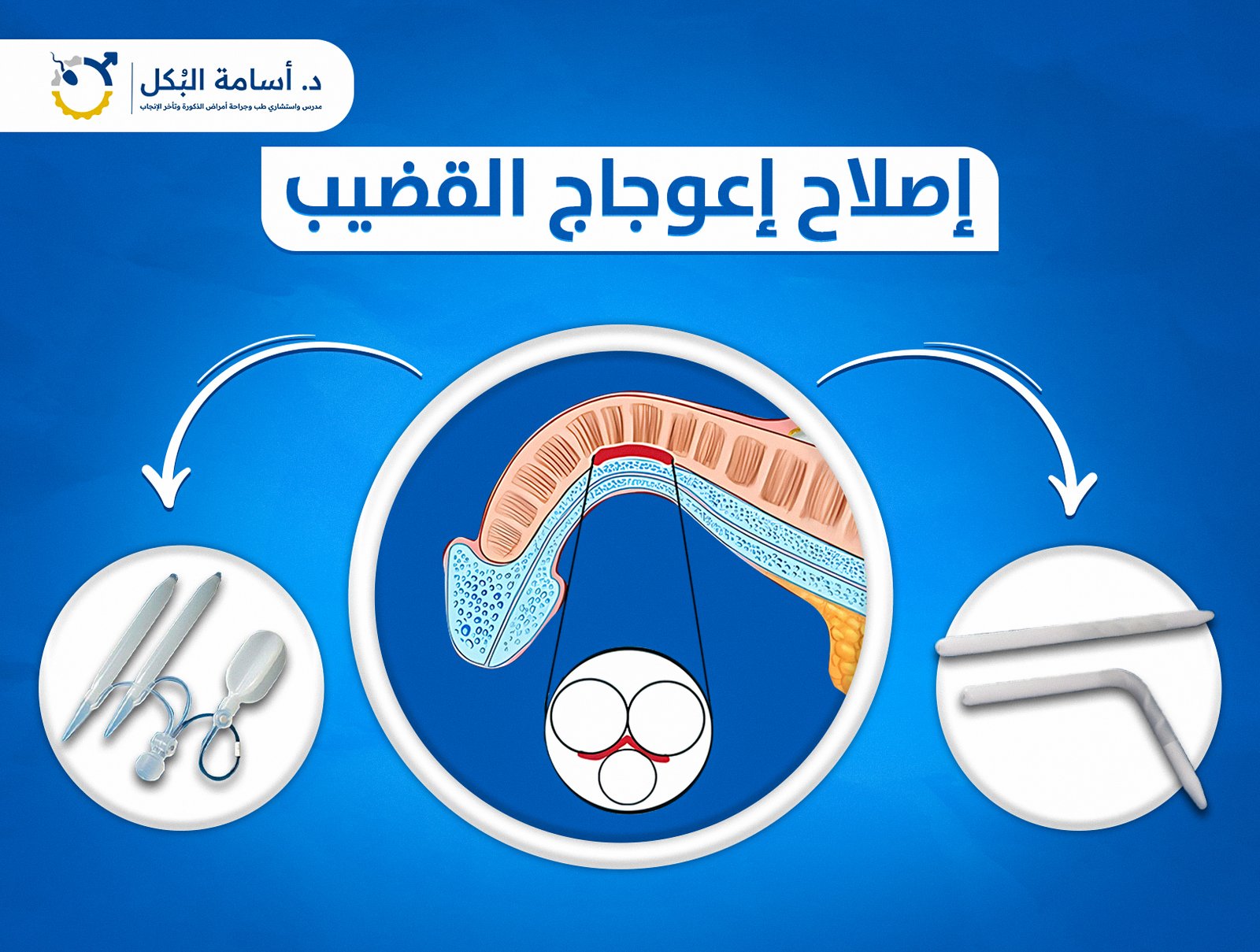 اصلاح اعوجاج القضيب