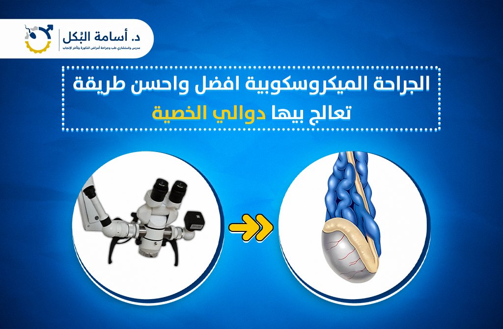 الجراحة الميكروسكوبية افضل واحسن طريقة تعالج بيها دوالي الخصية