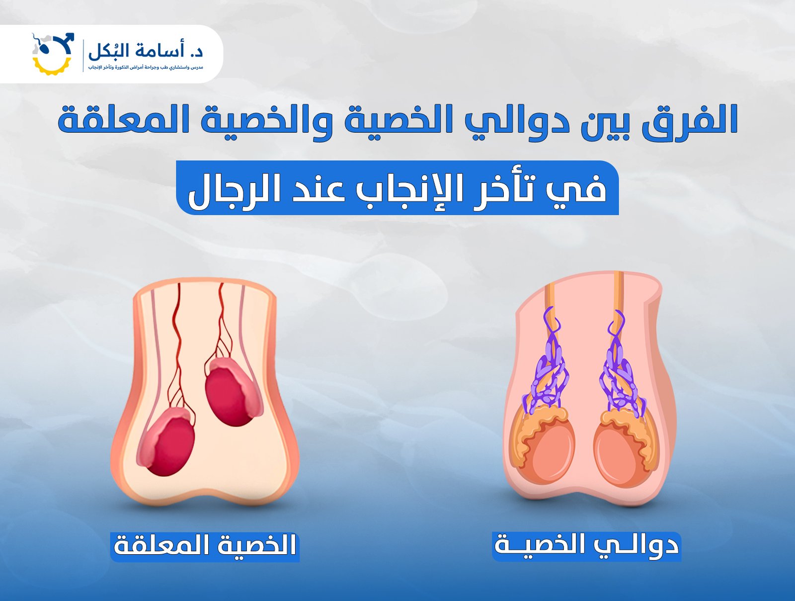 الفرق بين دوالي الخصية والخصية المعلقة في تأخر الإنجاب عند الرجال