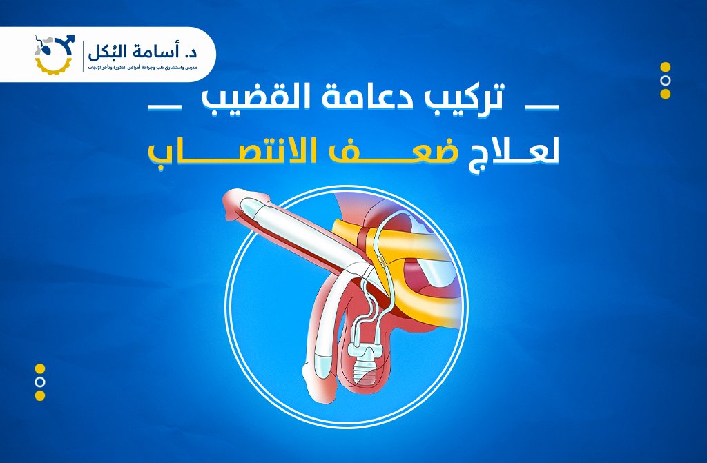 تركيب دعامة القضيب لعلاج ضعف الانتصاب