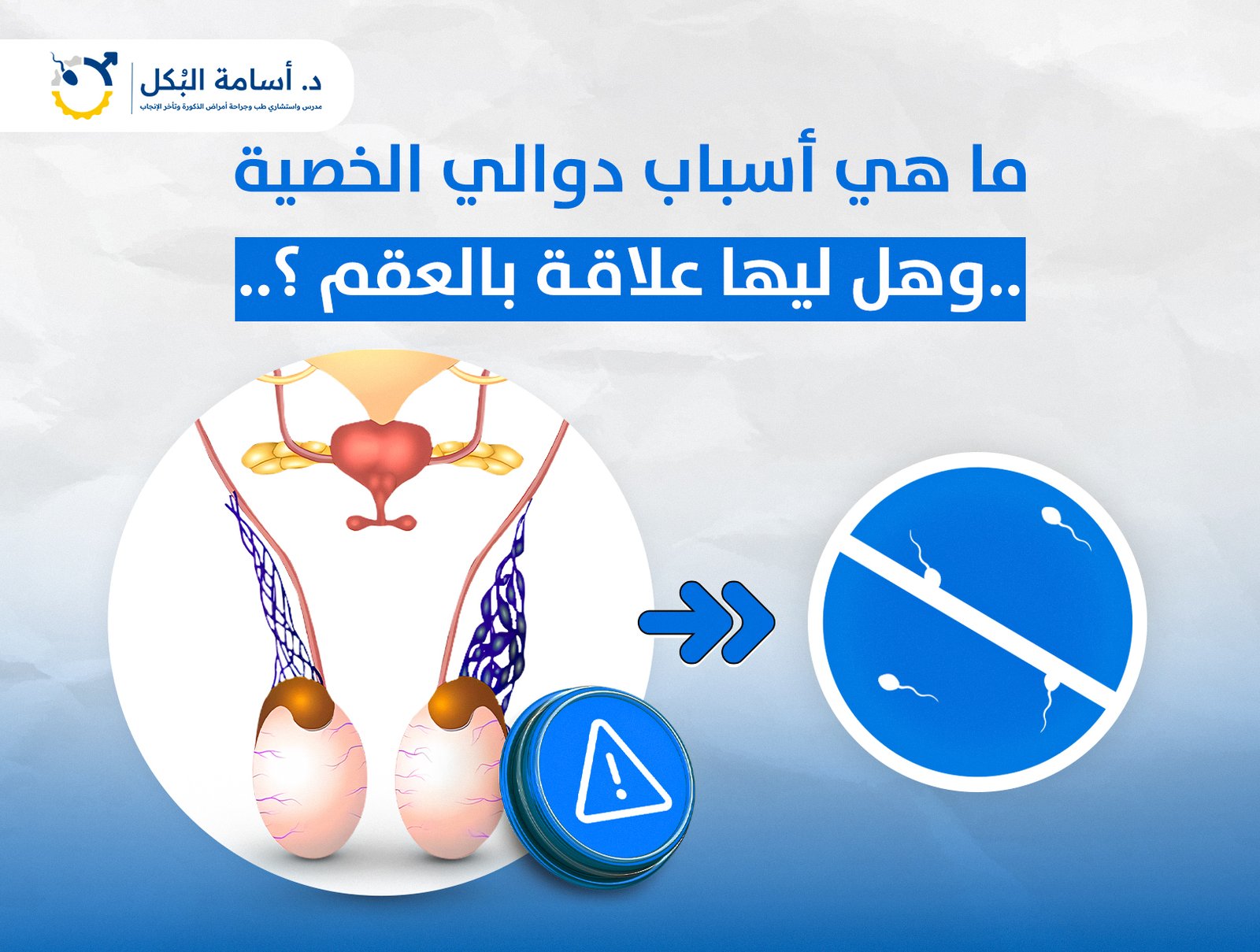 ما هي اسباب دوالي الخصية وهل ليها علاقة بالعقم ؟