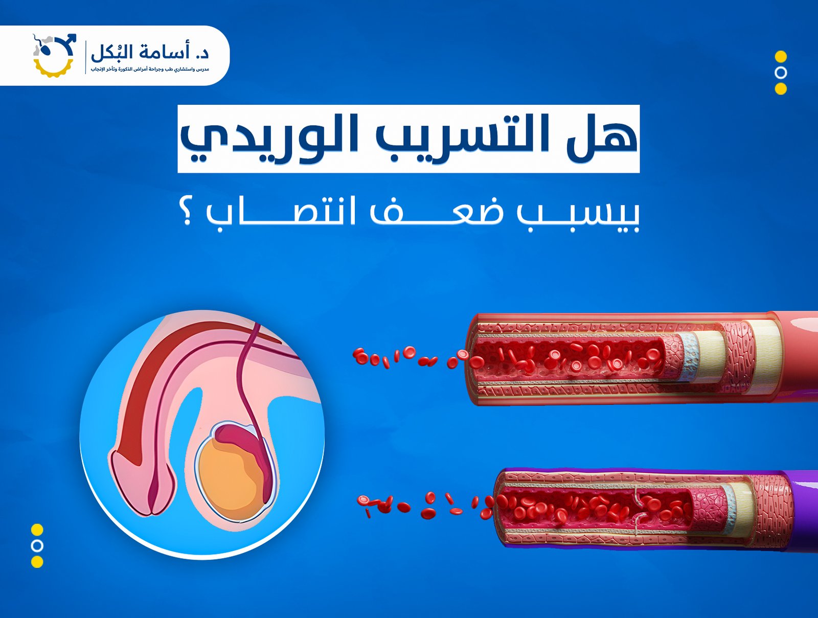 هل التسرب الوريدي بيسبب ضعف انتصاب؟