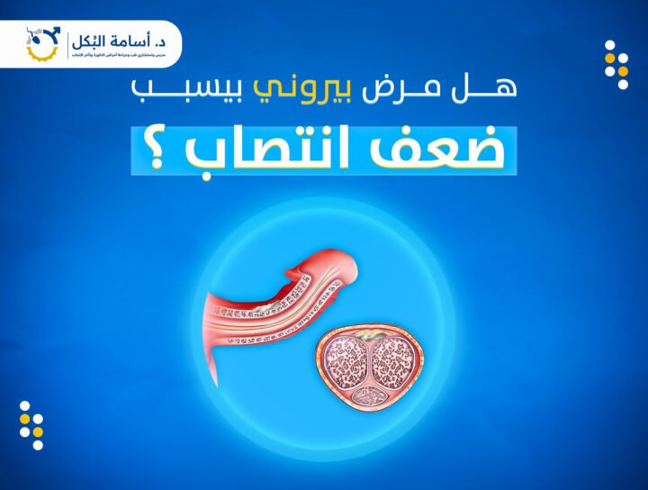 هل مرض بيروني بيسبب ضعف الانتصاب؟
