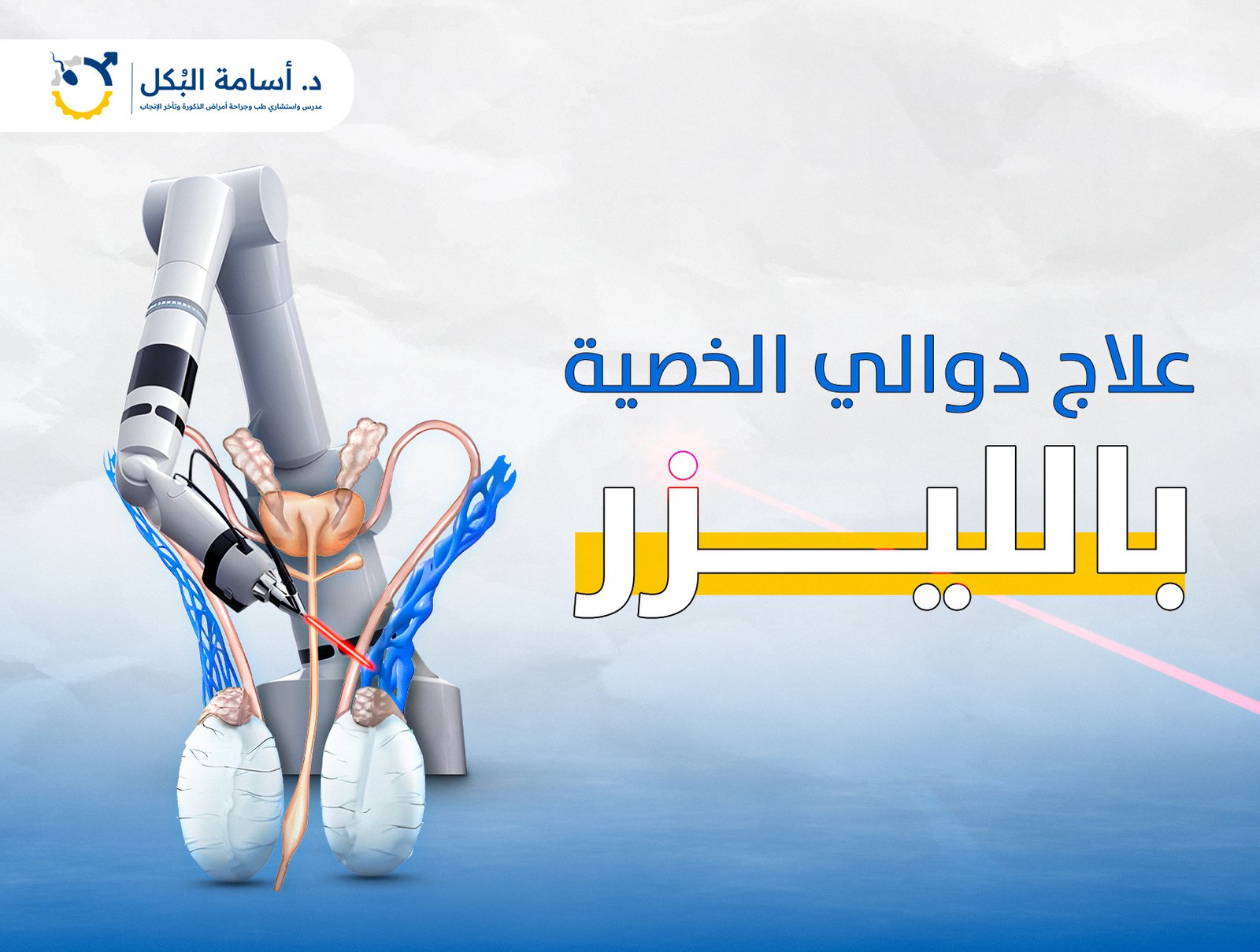 علاج دوالي الخصية بالليزر