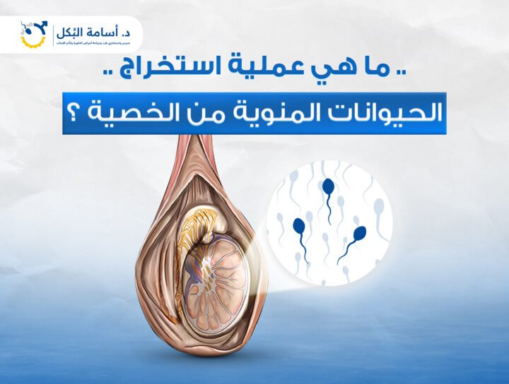 ما هي عملية استخراج الحيوانات المنوية من الخصية ؟