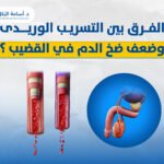 الفرق بين التسريب الوريدى وضعف ضخ الدم في القضيب ؟