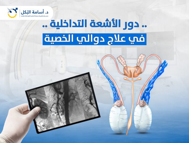 دور الأشعة التداخلية في علاج دوالي الخصية