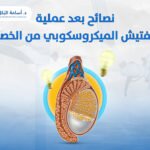 نصائح بعد عملية التفتيش الميكروسكوبي من الخصية