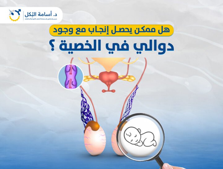 هل ممكن يحصل انجاب مع وجود دوالى فى الخصيه