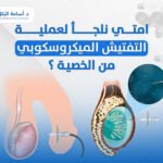 امتي نلجأ لعملية التفتيش الميكروسكوبي من الخصية ؟
