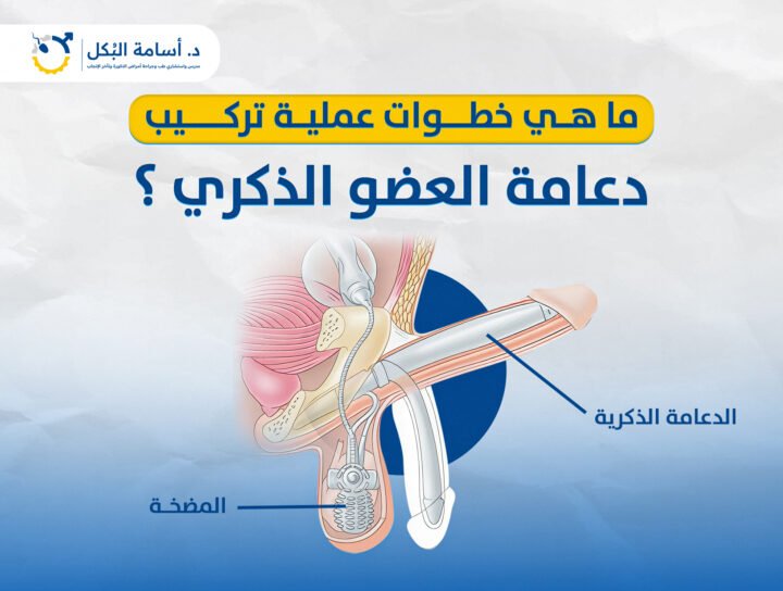 ما هي خطوات عملية تركيب دعامة العضو الذكري ؟
