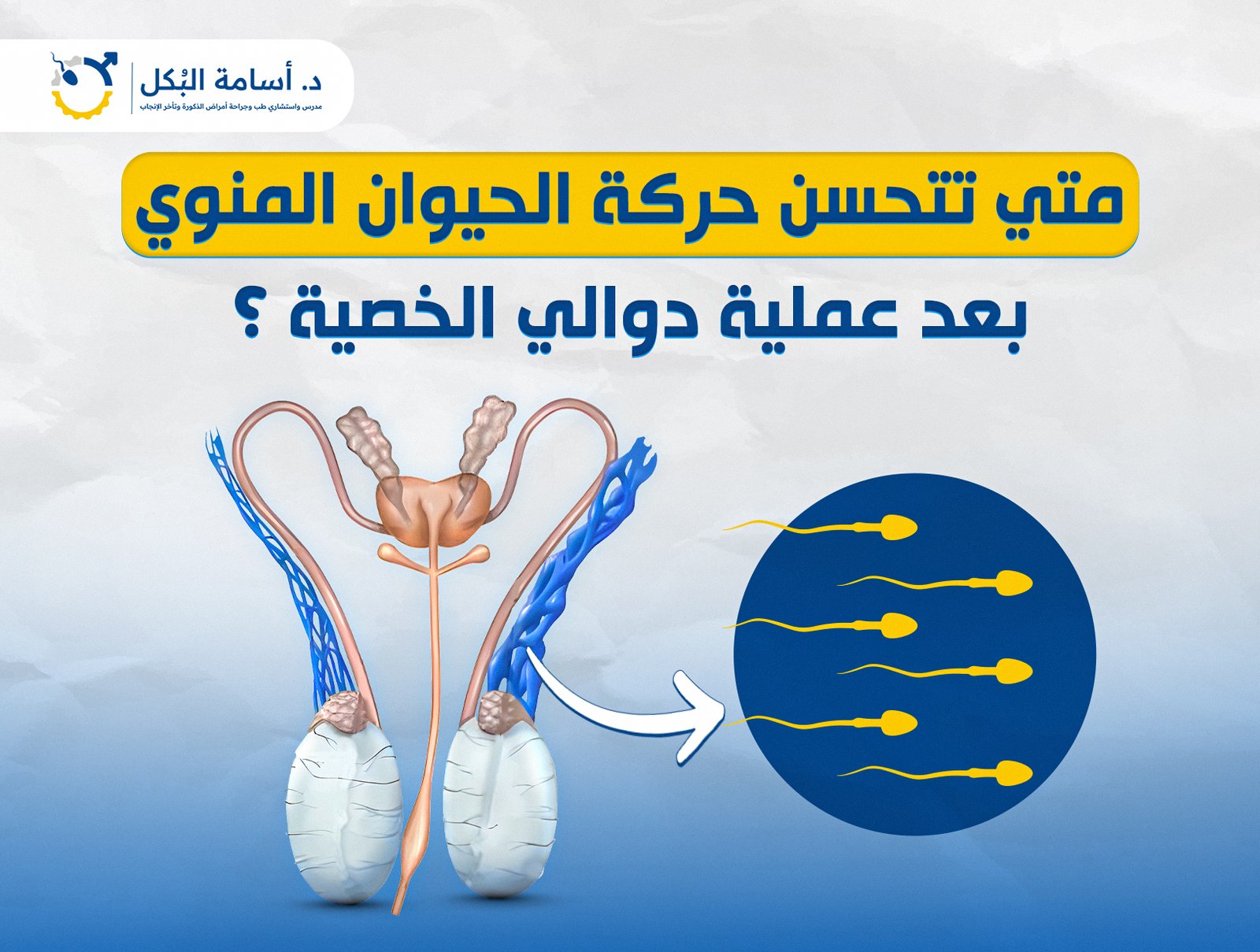 متي تتحسن حركة الحيوان المنوي بعد عملية دوالي الخصية ؟