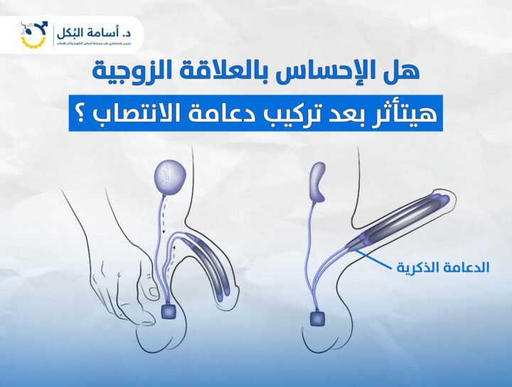 هل الإحساس بالعلاقة الزوجية هيتأثر بعد تركيب دعامة الانتصاب ؟