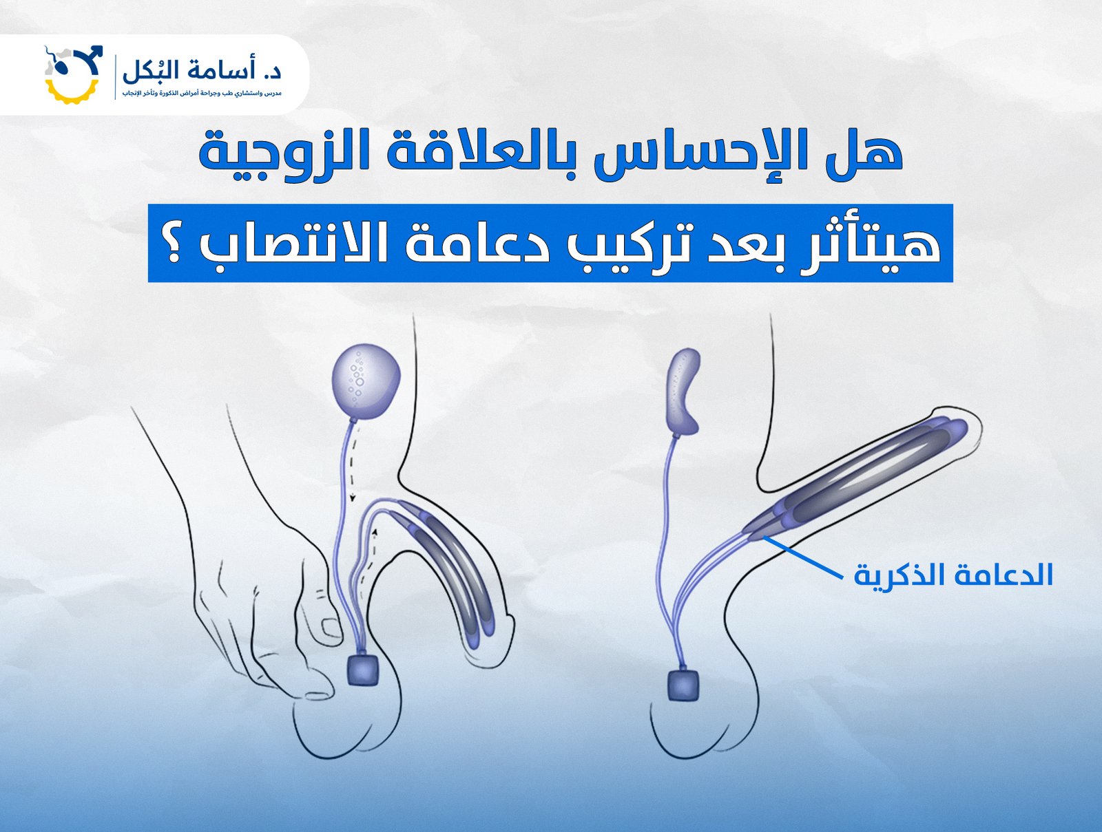 هل الإحساس بالعلاقة الزوجية هيتأثر بعد تركيب دعامة الانتصاب ؟