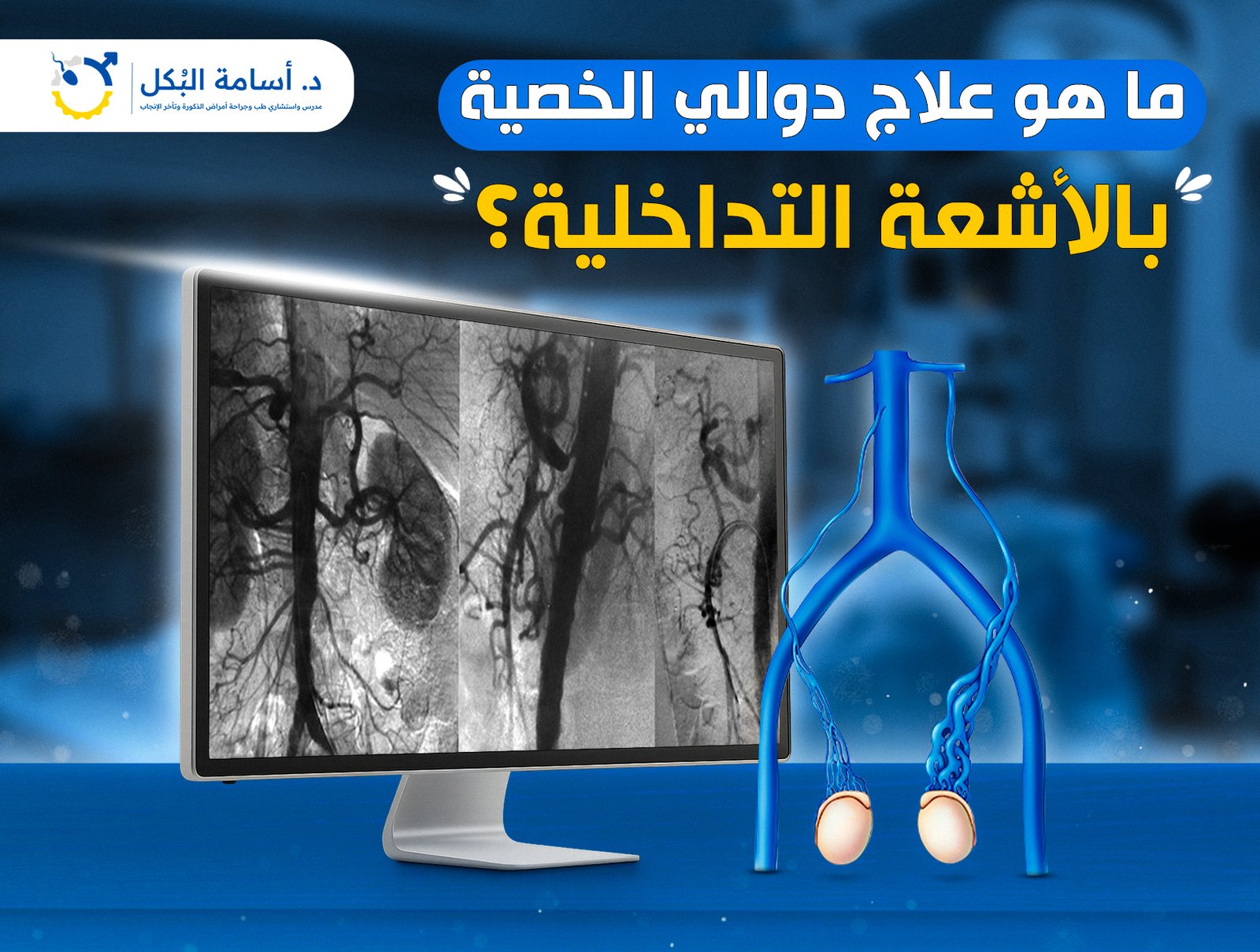 ما هو علاج دوالي الخصية بالأشعة التداخلية ؟