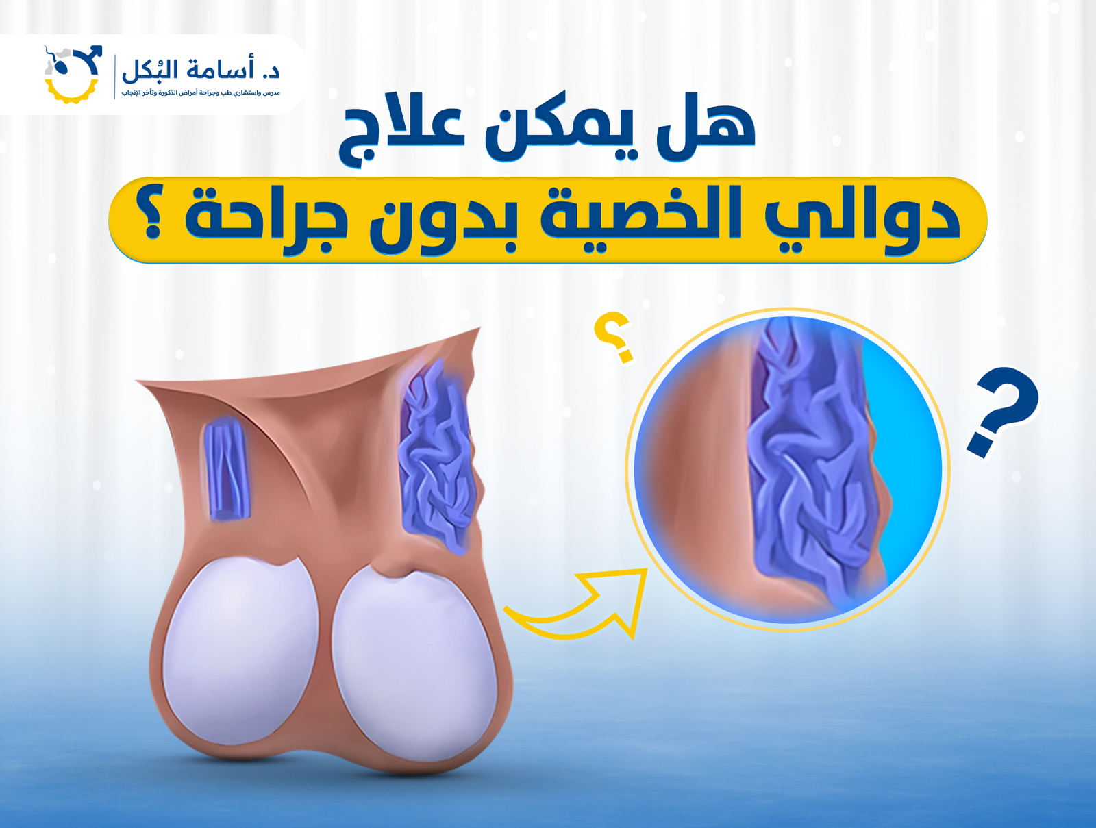 هل يمكن علاج دوالي الخصية بدون جراحة